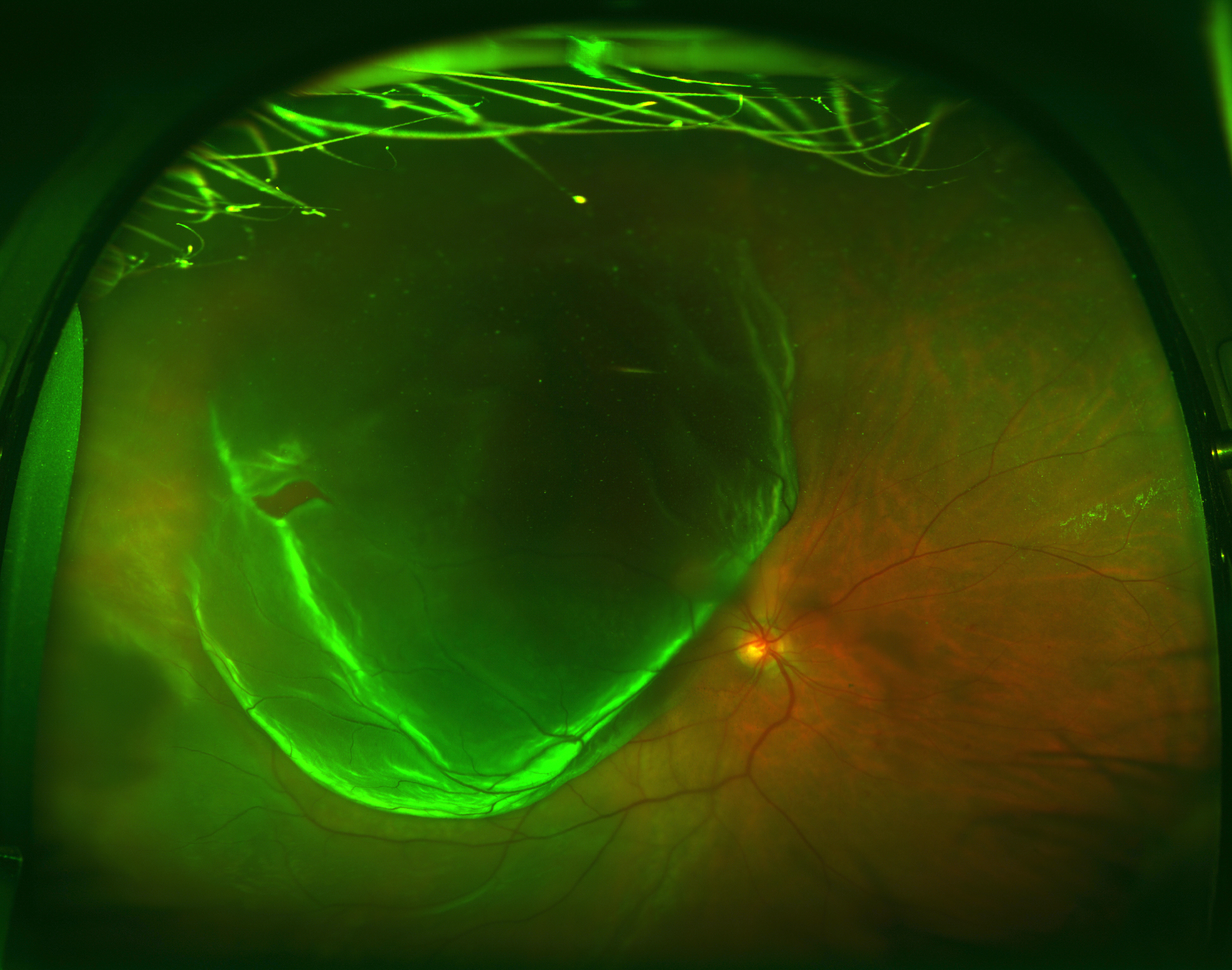 Retinal Detachment