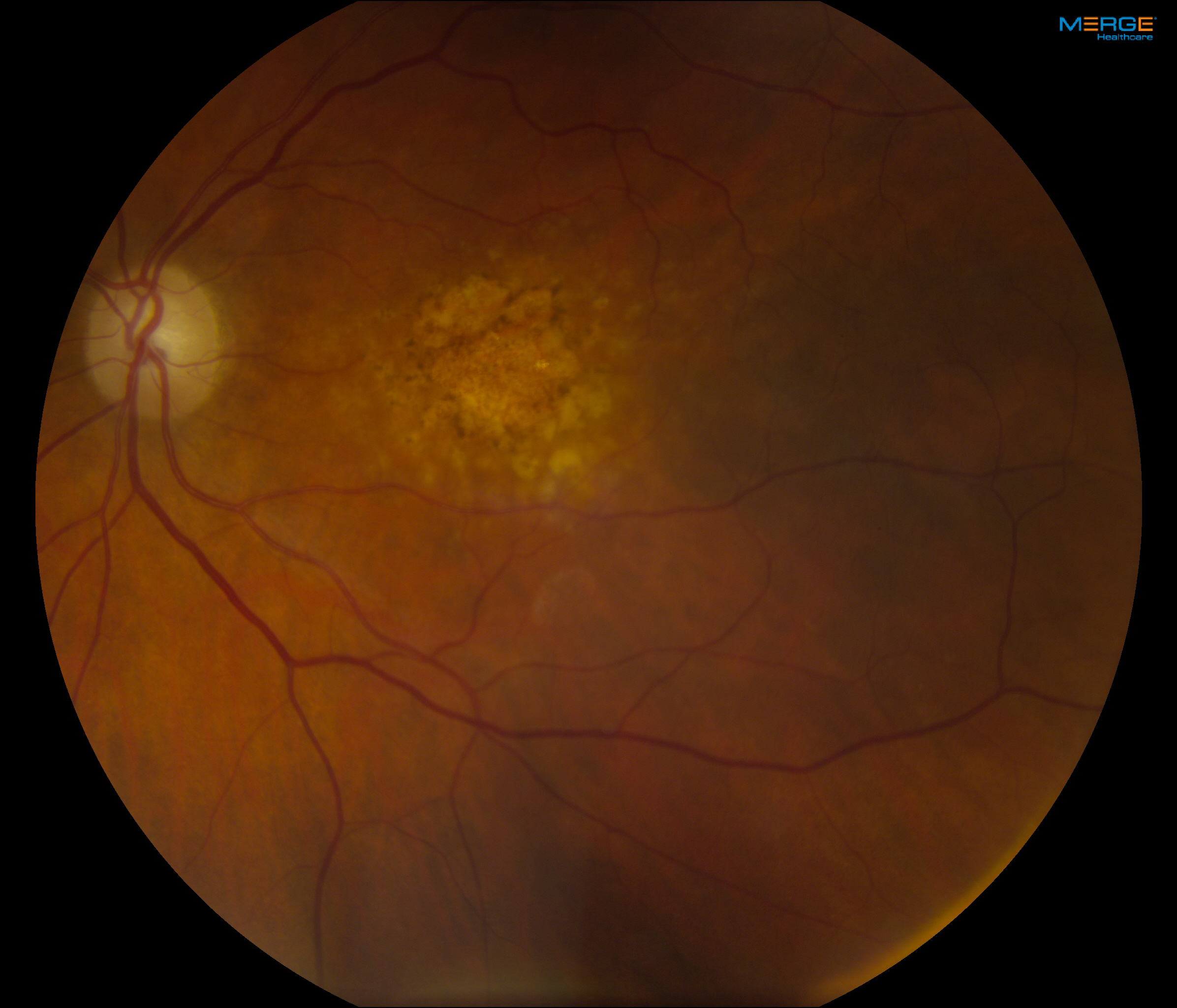 dry vs wet macular degeneration