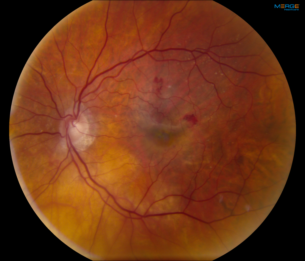 Age-Related Macular Degeneration—Dry and Wet – Retina Group of New England