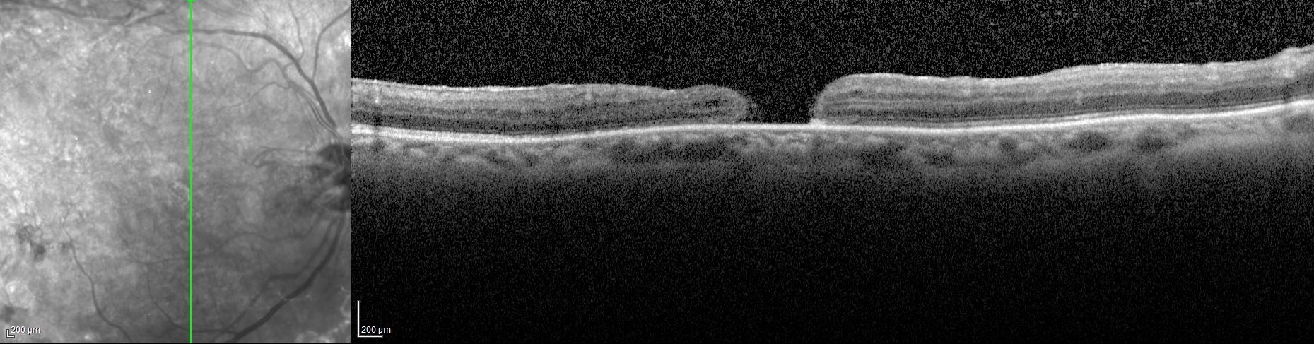 深水光太strong macula