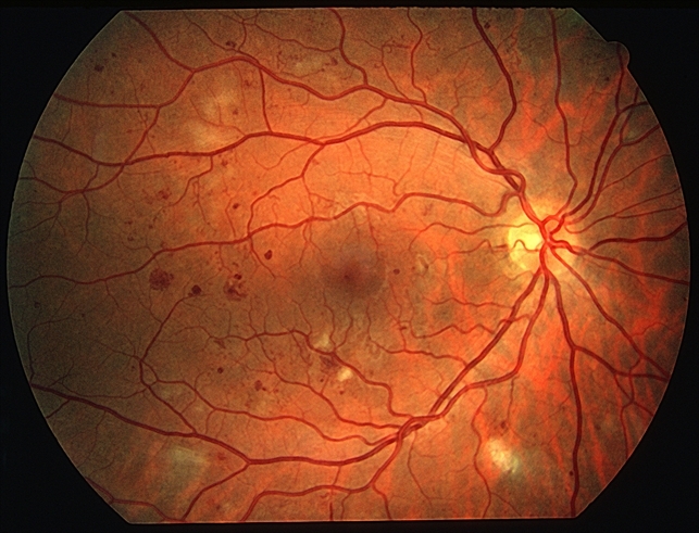 Diabetic retinopathy retinal damage